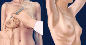 Возможные операции в области маммопластике (пластика груди) Bild